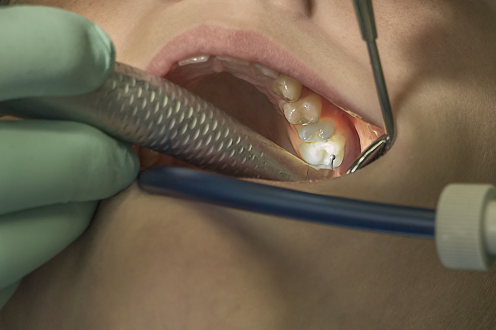 Equipo y sillón dental en Clínica Moyúa, Bilbao