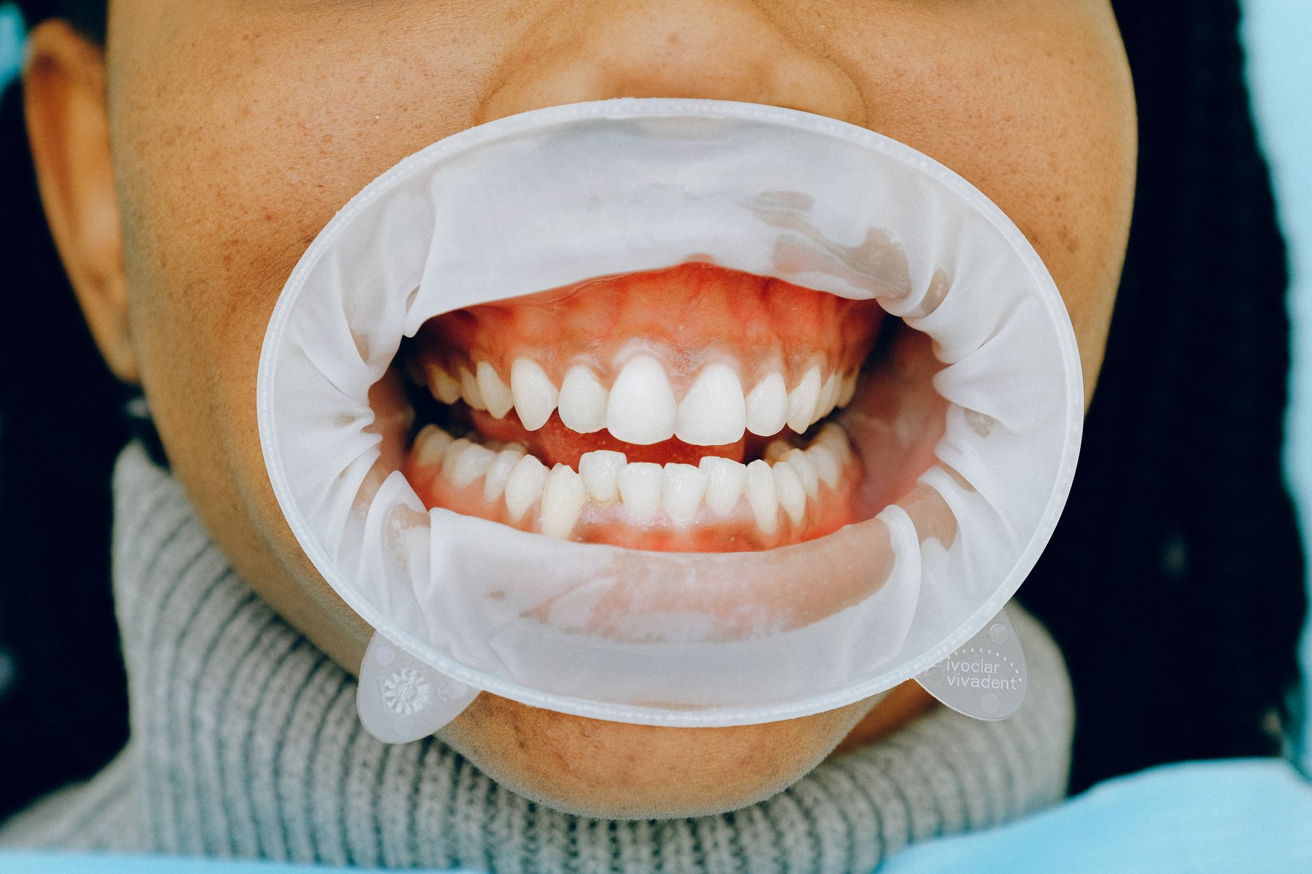 Periodoncia y tratamiento de encías en Valladolid